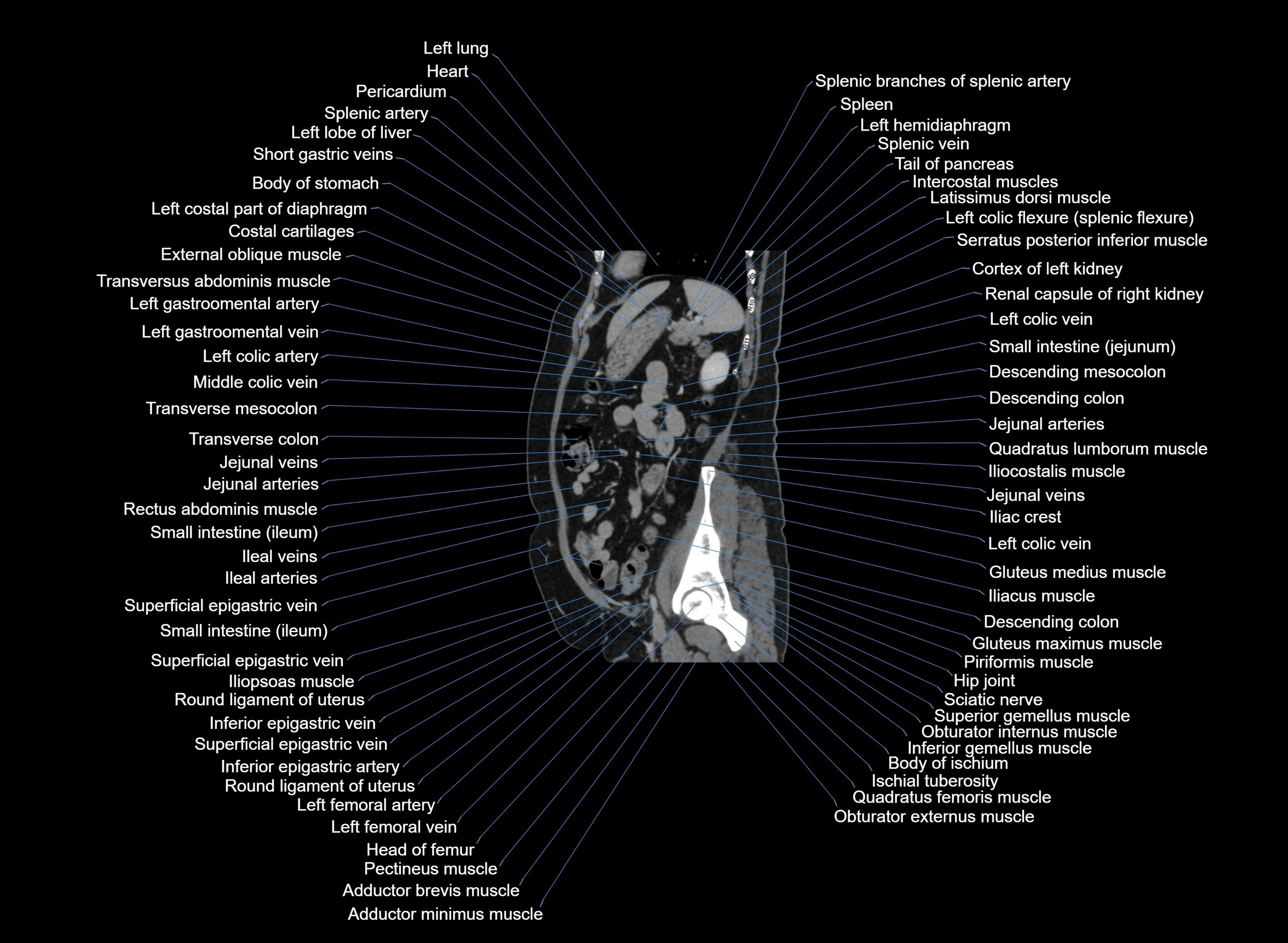 CT Abdomen sagittal cross sectional anatomy labelled radiology image -00033.webp